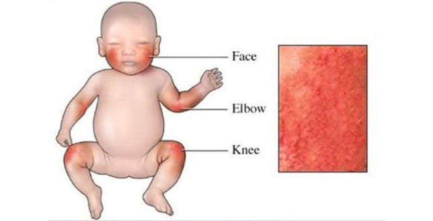 Kulit Kering Kemerahan, Gatal, Bersisik, Tanda Dermatitis Atopik